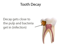 tooth decay arizona dentist