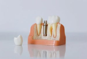 Gum Disease