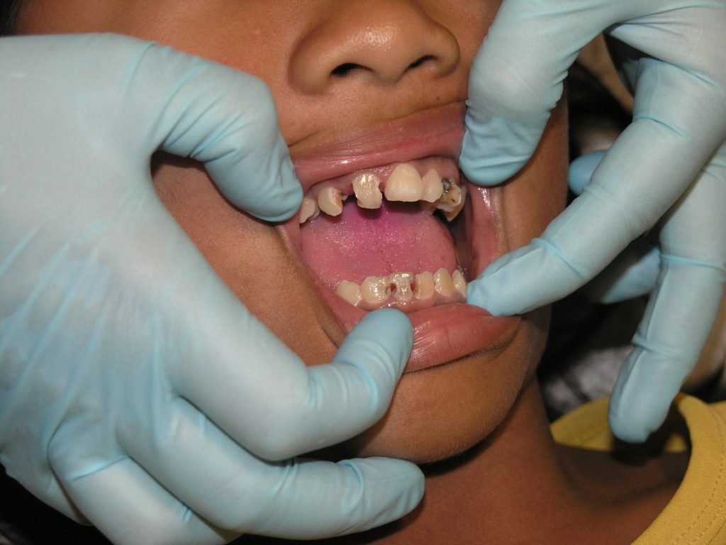 Damaged Teeth Damaged Teeth