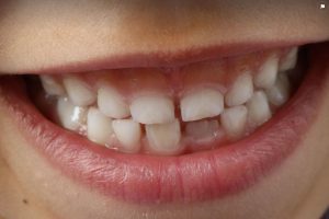 Malocclusion