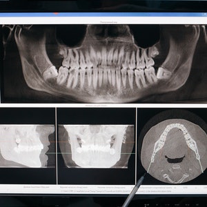 Is It Safe to Have Dental X-Rays?
