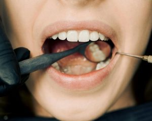 a close up photo of teeth examination